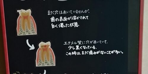 虫歯の進行について